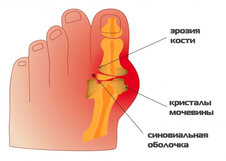 Подагра