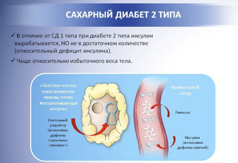 Диабет второго типа